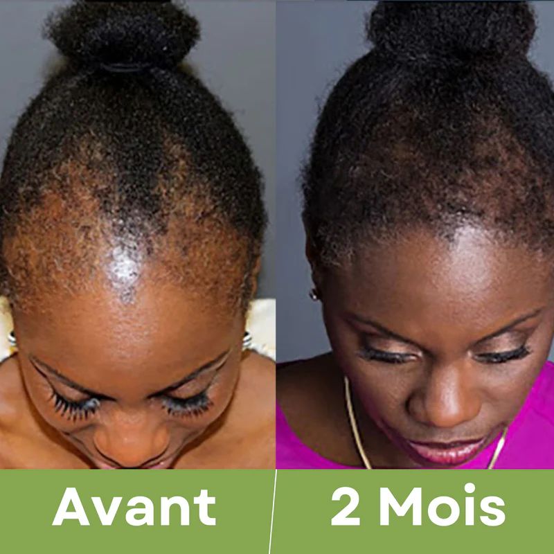 Élixir Capillaire 3-en-1 ( 01 acheté = 01 offert ) • Croissance, Force & Nutrition Intense.